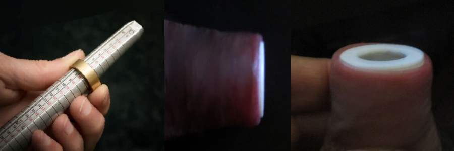 Adult Phimosis, Solution without operation