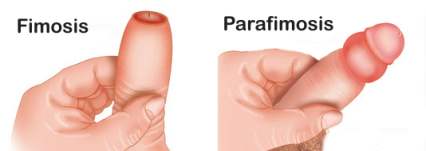 Adult Phimosis, Solution without operation